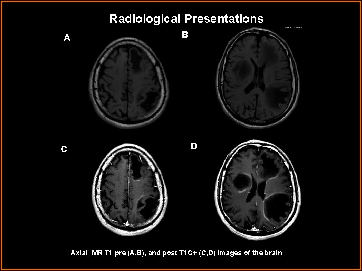 Radiological Presentations A C B D Axial MR T 1 pre (A, B), and