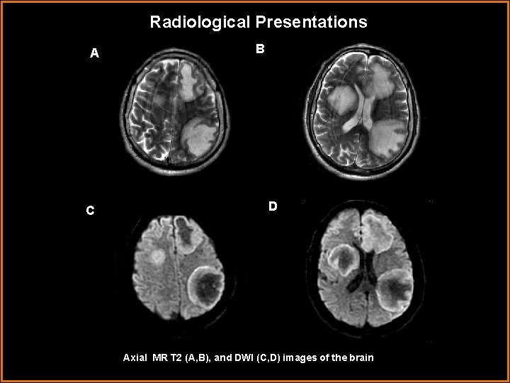 Radiological Presentations A C B D Axial MR T 2 (A, B), and DWI