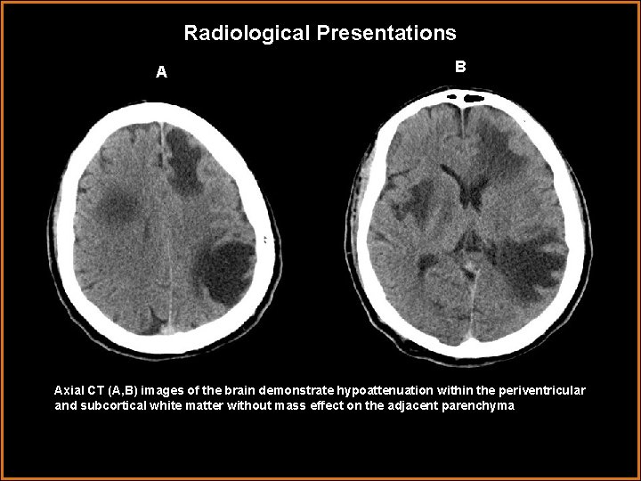 Radiological Presentations A B Axial CT (A, B) images of the brain demonstrate hypoattenuation