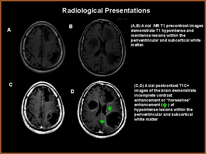 Radiological Presentations A B C D (A, B) Axial MR T 1 precontrast images