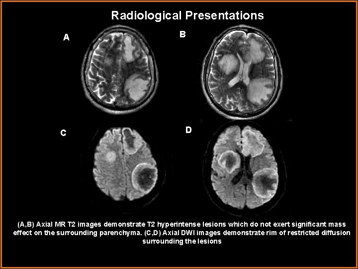 Radiological Presentations A C B D (A, B) Axial MR T 2 images demonstrate