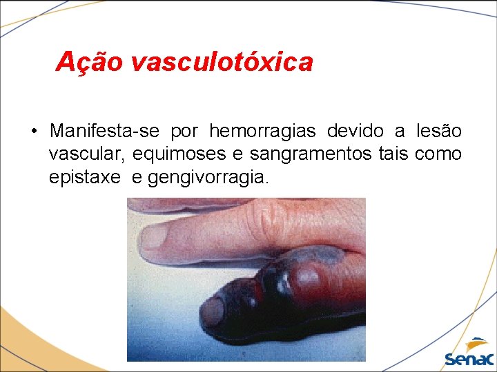 Ação vasculotóxica • Manifesta-se por hemorragias devido a lesão vascular, equimoses e sangramentos tais Ação vasculotóxica • Manifesta-se por hemorragias devido a lesão vascular, equimoses e sangramentos tais