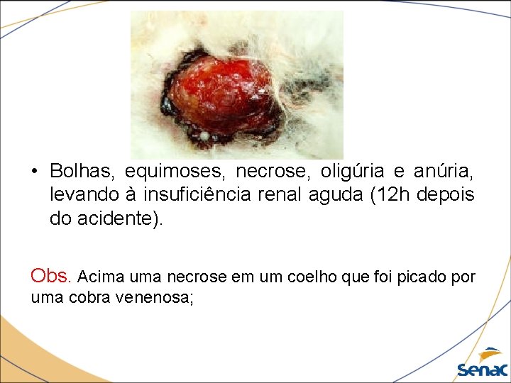  • Bolhas, equimoses, necrose, oligúria e anúria, levando à insuficiência renal aguda (12