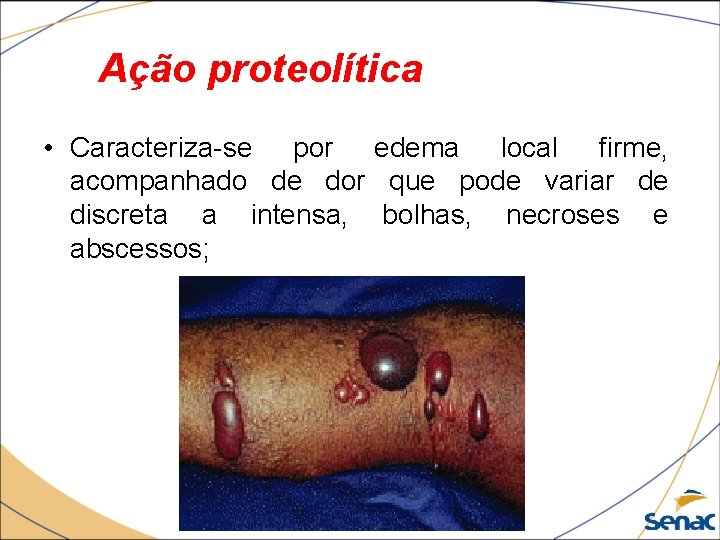 Ação proteolítica • Caracteriza-se por edema local firme, acompanhado de dor que pode variar Ação proteolítica • Caracteriza-se por edema local firme, acompanhado de dor que pode variar