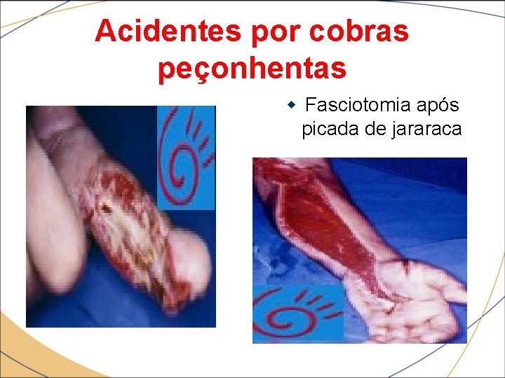 Acidentes por cobras peçonhentas Fasciotomia após picada de jararaca 