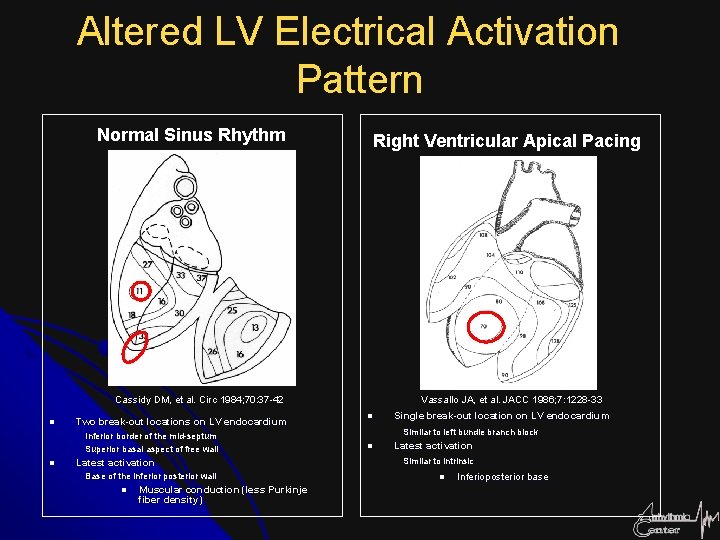 Altered LV Electrical Activation Pattern Normal Sinus Rhythm Right Ventricular Apical Pacing Cassidy DM,