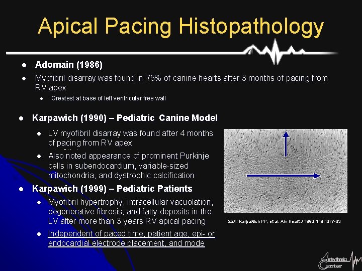Apical Pacing Histopathology l Adomain (1986) l Myofibril disarray was found in 75% of