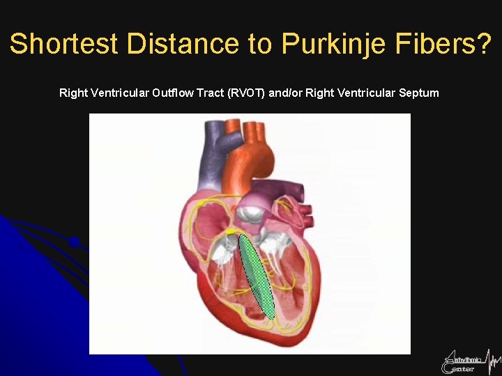 Shortest Distance to Purkinje Fibers? Right Ventricular Outflow Tract (RVOT) and/or Right Ventricular Septum