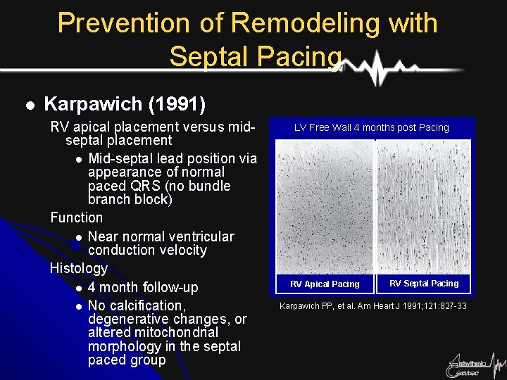 Prevention of Remodeling with Septal Pacing l Karpawich (1991) RV apical placement versus midseptal