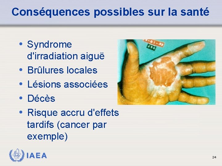 Conséquences possibles sur la santé • Syndrome • • d'irradiation aiguë Brûlures locales Lésions