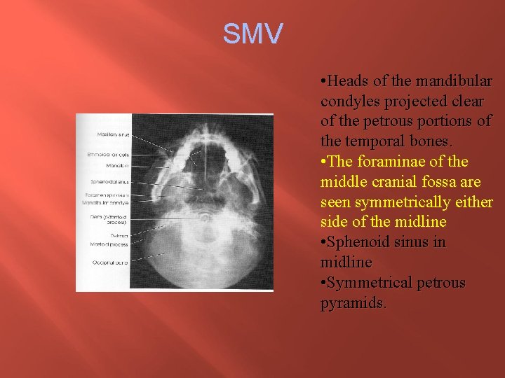 SMV • Heads of the mandibular condyles projected clear of the petrous portions of