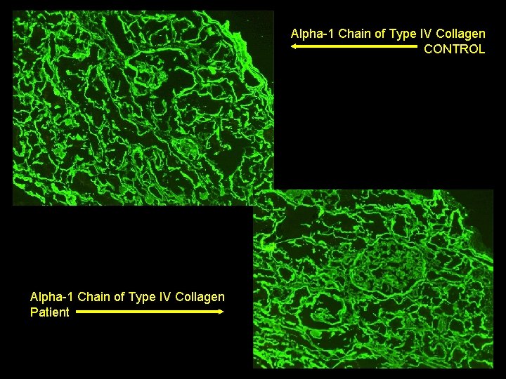 Alpha-1 Chain of Type IV Collagen CONTROL Alpha-1 Chain of Type IV Collagen Patient