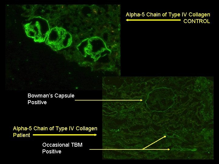 Alpha-5 Chain of Type IV Collagen CONTROL Bowman’s Capsule Positive Alpha-5 Chain of Type