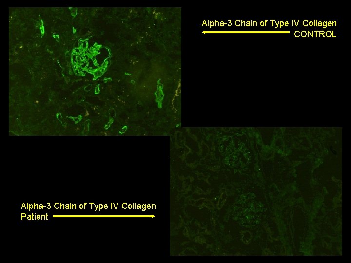 Alpha-3 Chain of Type IV Collagen CONTROL Alpha-3 Chain of Type IV Collagen Patient