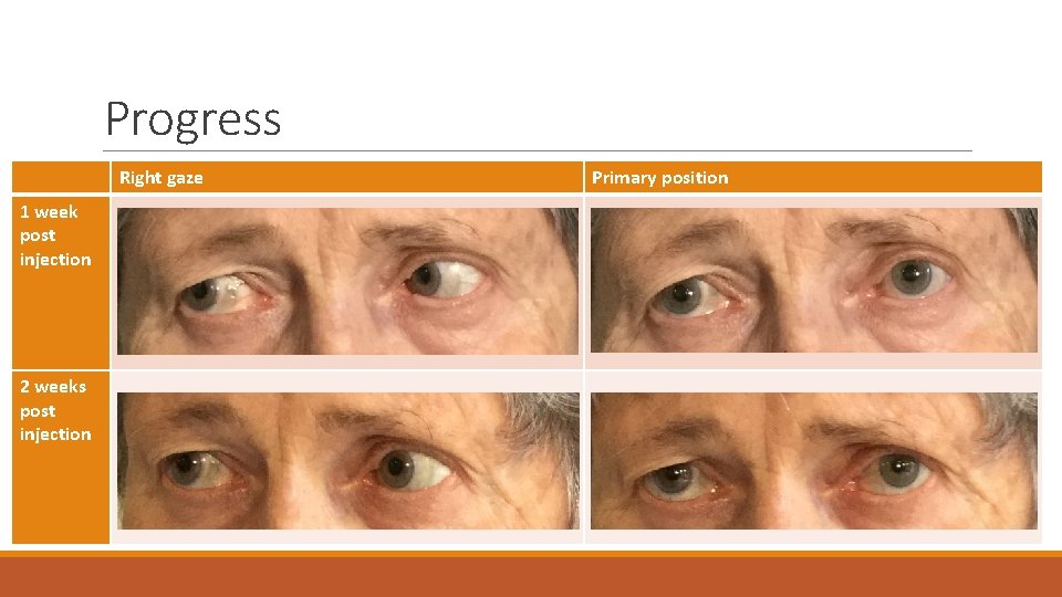 Progress Right gaze 1 week post injection 2 weeks post injection Primary position 