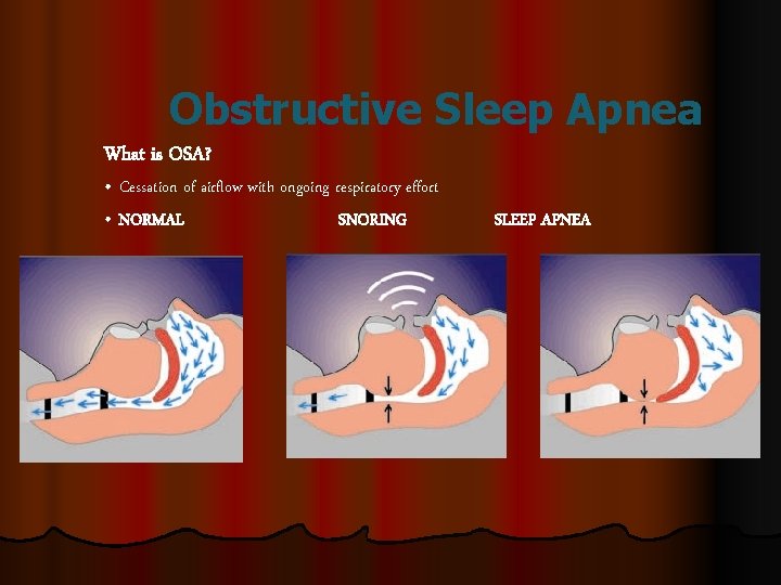 Obstructive Sleep Apnea What is OSA? • Cessation of airflow with ongoing respiratory effort