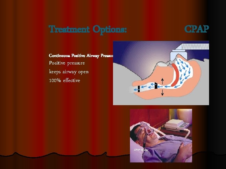 Treatment Options: CPAP Continuous Positive Airway Pressure Positive pressure keeps airway open 100% effective