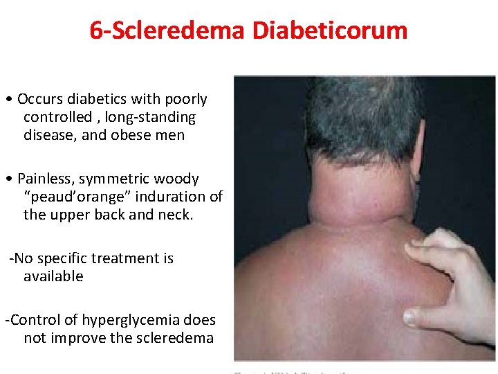 scleredema diabeticorum)