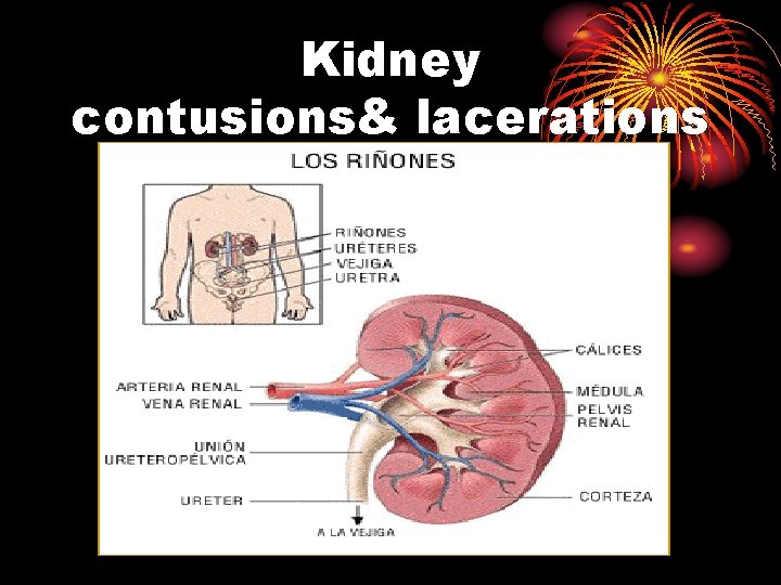 Kidney contusions& lacerations 