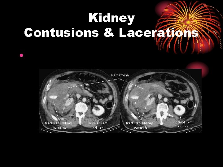 Kidney Contusions & Lacerations • 