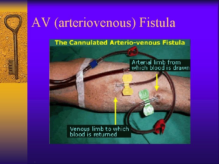 AV (arteriovenous) Fistula . 