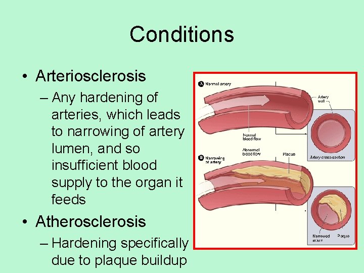 Conditions • Arteriosclerosis – Any hardening of arteries, which leads to narrowing of artery