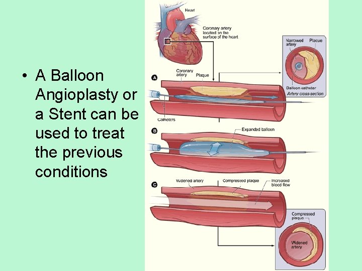  • A Balloon Angioplasty or a Stent can be used to treat the