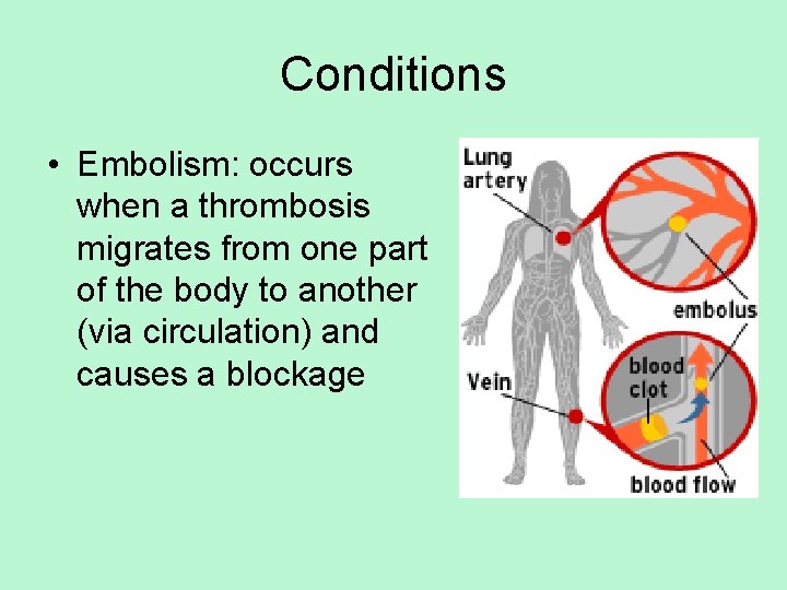 Conditions • Embolism: occurs when a thrombosis migrates from one part of the body