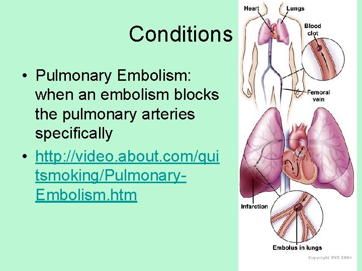 Conditions • Pulmonary Embolism: when an embolism blocks the pulmonary arteries specifically • http: