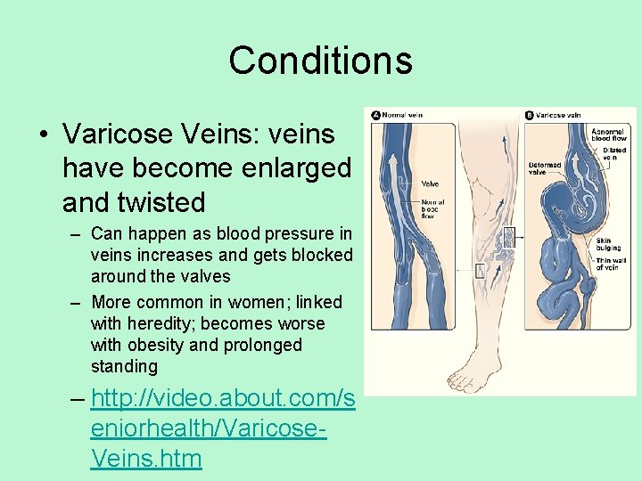 Conditions • Varicose Veins: veins have become enlarged and twisted – Can happen as