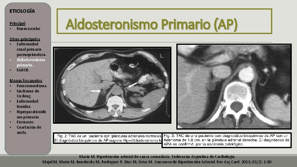 ETIOLOGÍA Aldosteronismo Primario (AP) Principal • Renovascular. Otras principales • Enfermedad renal primaria parenquimatosa. ETIOLOGÍA Aldosteronismo Primario (AP) Principal • Renovascular. Otras principales • Enfermedad renal primaria parenquimatosa.