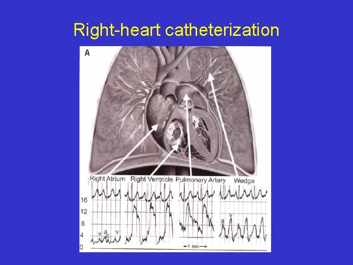 Right-heart catheterization 