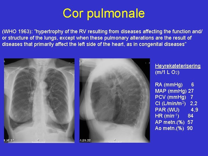 Cor pulmonale (WHO 1963): ”hypertrophy of the RV resulting from diseases affecting the function
