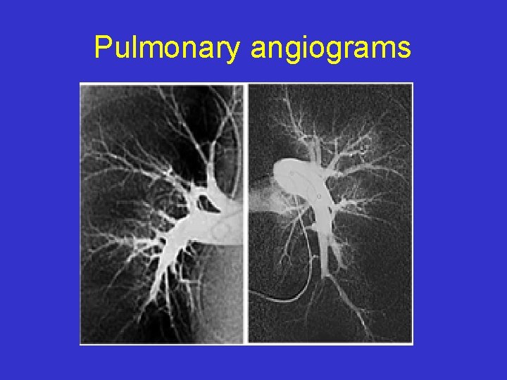 Pulmonary angiograms 