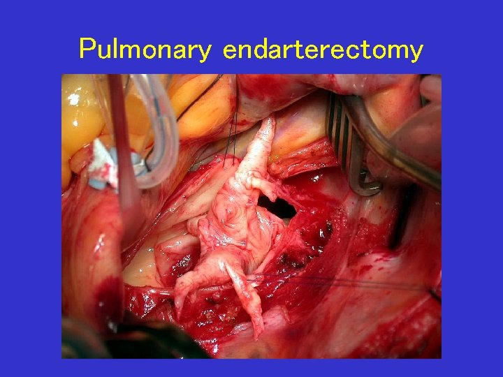 Pulmonary endarterectomy 