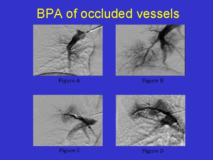 BPA of occluded vessels 