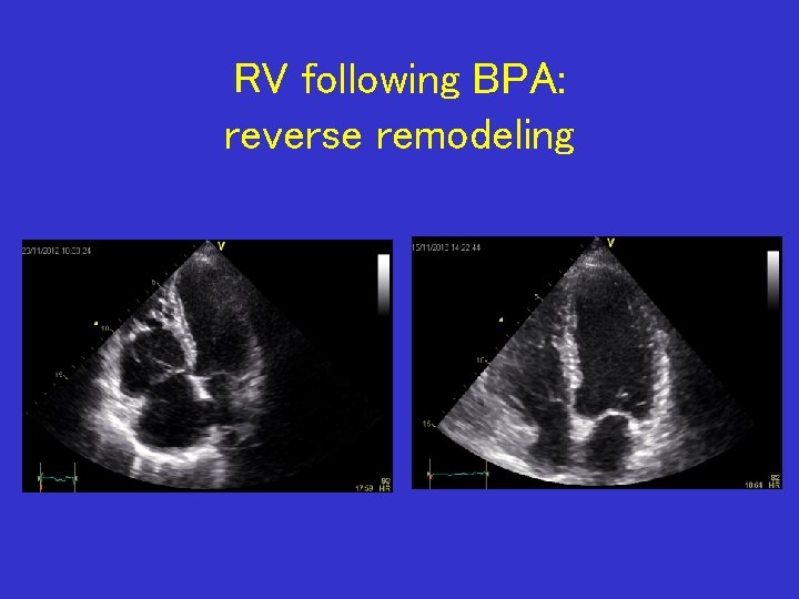 RV following BPA: reverse remodeling 