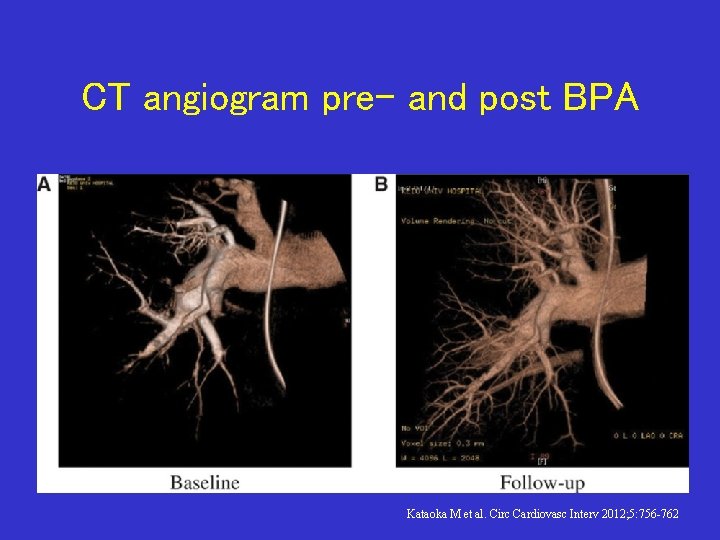 CT angiogram pre- and post BPA Kataoka M et al. Circ Cardiovasc Interv 2012;