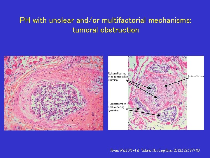 PH with unclear and/or multifactorial mechanisms: tumoral obstruction Freim Wahl SG et al. Tidsskr
