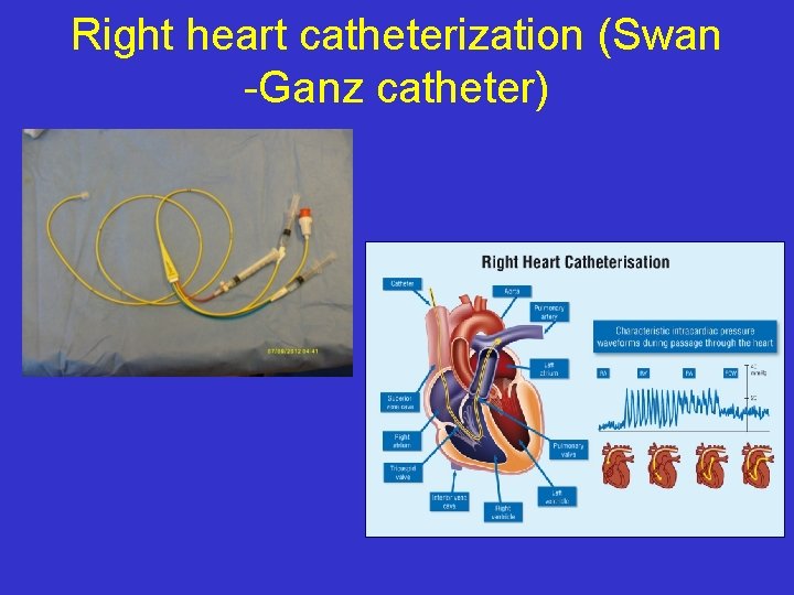Right heart catheterization (Swan -Ganz catheter) 