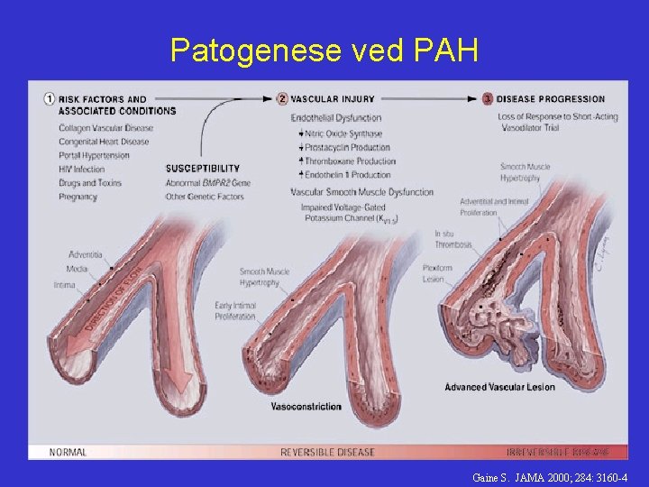 Patogenese ved PAH Gaine S. JAMA 2000; 284: 3160 -4 