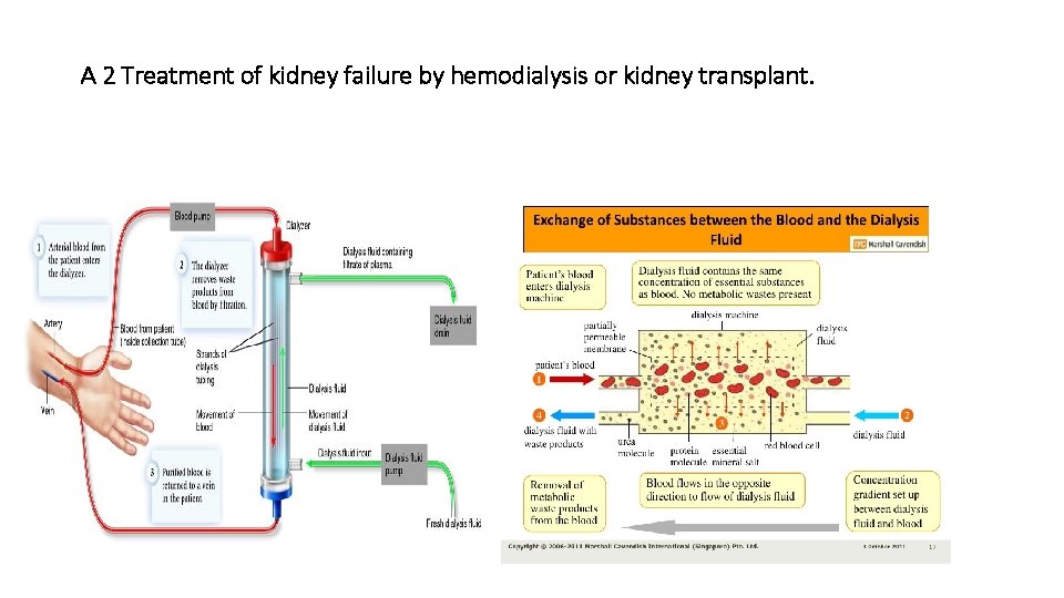 A 2 Treatment of kidney failure by hemodialysis or kidney transplant. 