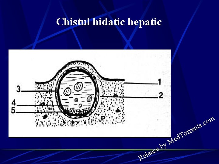 Chistul hidatic hepatic n o c. ts M e r r o T d Chistul hidatic hepatic n o c. ts M e r r o T d