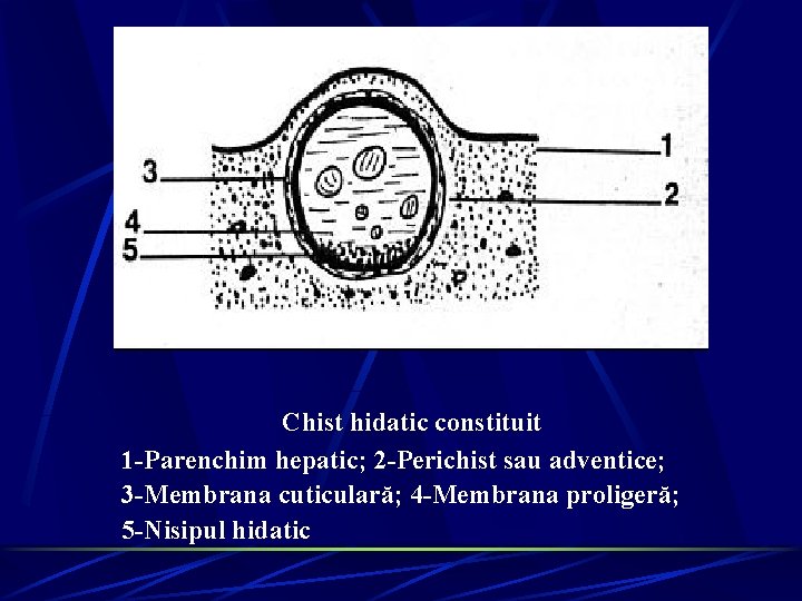 Chist hidatic constituit 1 -Parenchim hepatic; 2 -Perichist sau adventice; 3 -Membrana cuticulară; 4 Chist hidatic constituit 1 -Parenchim hepatic; 2 -Perichist sau adventice; 3 -Membrana cuticulară; 4