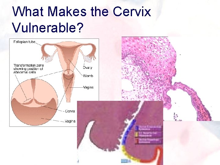 What Makes the Cervix Vulnerable? 