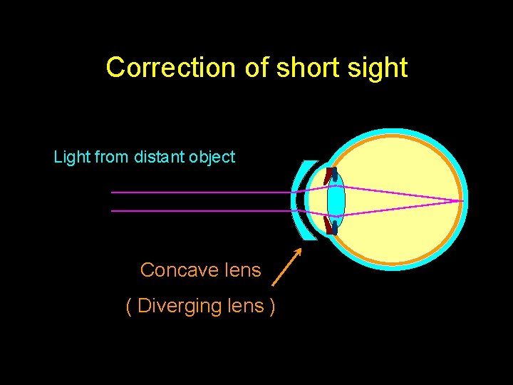 Correction of short sight Light from distant object Concave lens ( Diverging lens )