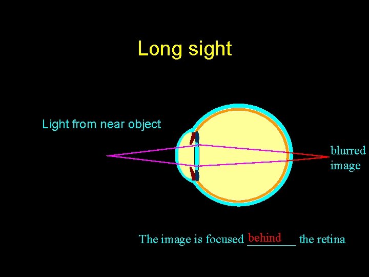 Long sight Light from near object blurred image behind the retina The image is