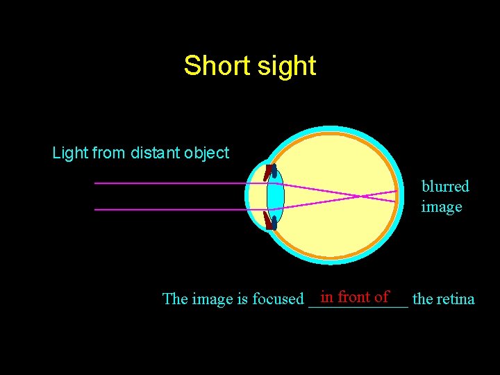 Short sight Light from distant object blurred image in front of the retina The