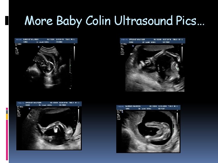 More Baby Colin Ultrasound Pics… More Baby Colin Ultrasound Pics…