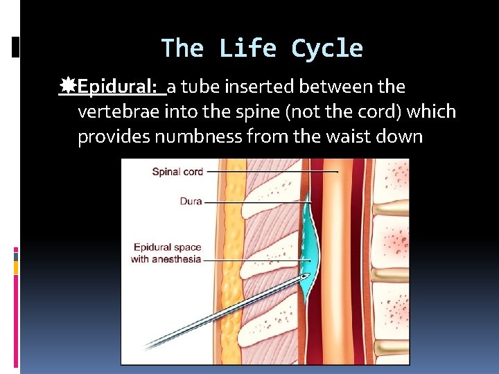 The Life Cycle Epidural: a tube inserted between the vertebrae into the spine (not The Life Cycle Epidural: a tube inserted between the vertebrae into the spine (not